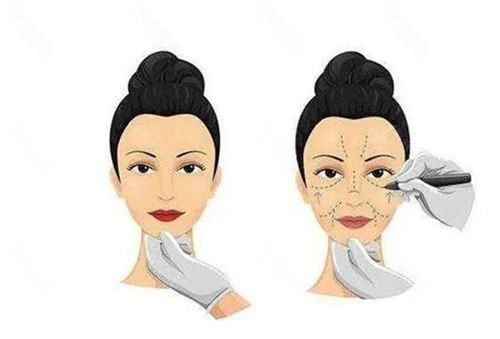 线雕和拉皮怎么选？上海面部提升与轮廓固定一篇讲清楚